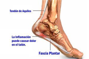 Fascitis plantar (Foto: Saluspot)