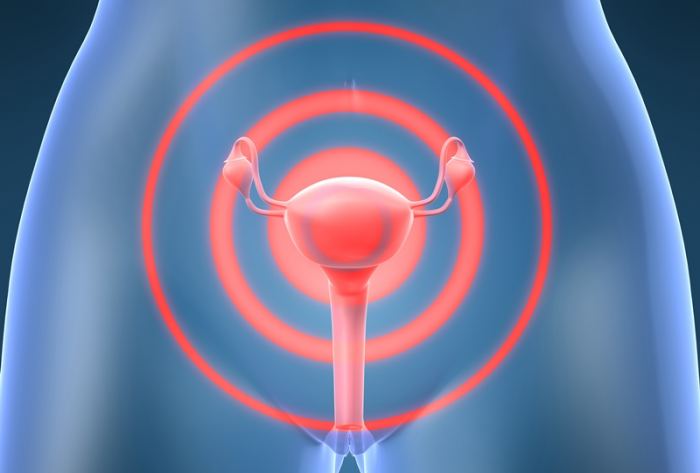 histerectomía utero