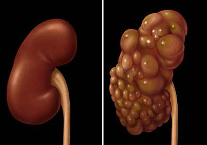 Poliquistosis Renal