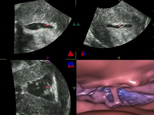 Pólipos y adherencia en cavidad uterina visualizadas en 2 y 3 dimensiones