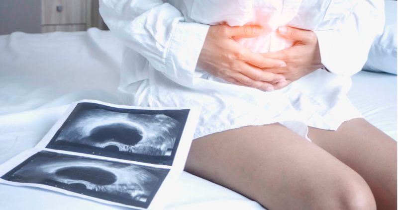 endometriosis
