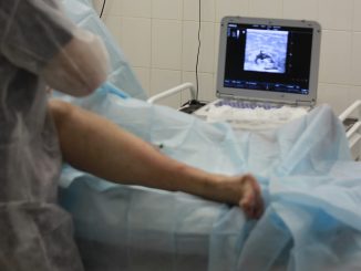 varices arañas vasculares